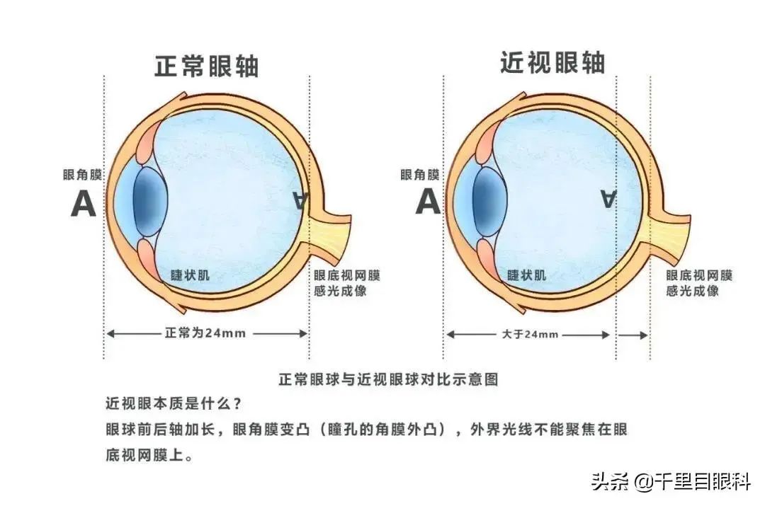 孩子近视度数没增加，眼轴为什么还在长？ - 北京眼科医院, 北京阜仁眼科医院 ,北京白内障治疗， 白内障超声乳化手术 ,北京白内障手术